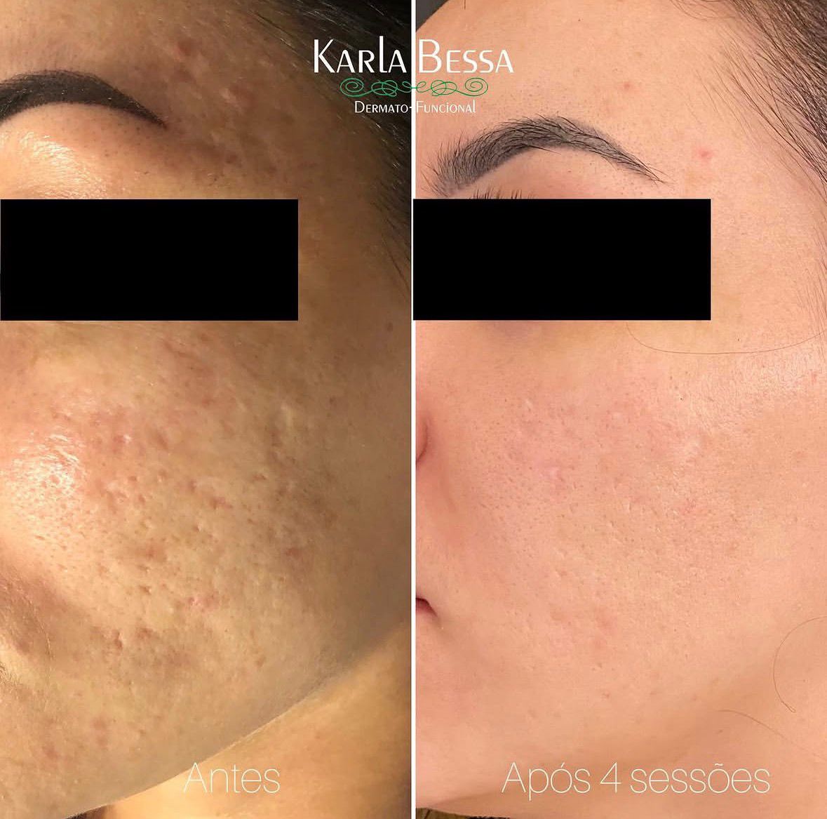 Antes e depois de cicatrizes de acne com CO2