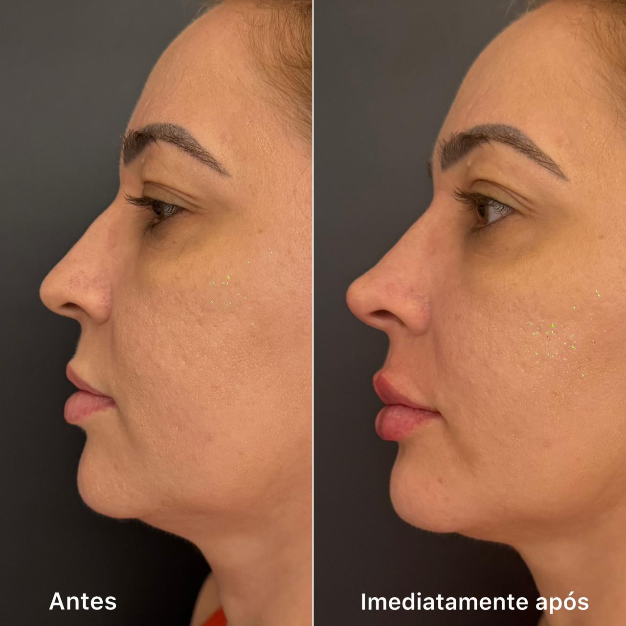 Antes e depois de harmonização facial