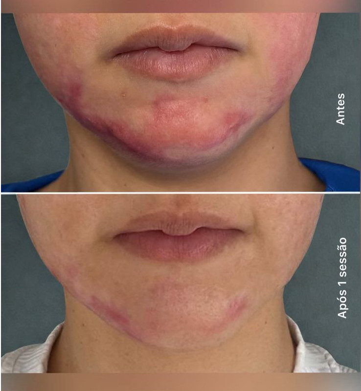 Antes e depois de queloides com CO2