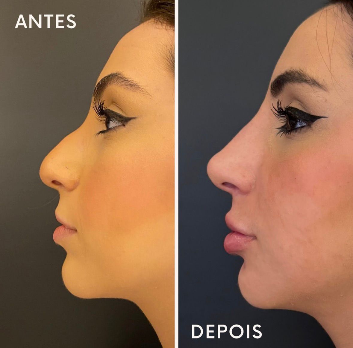 Antes e depois de rinomodelação