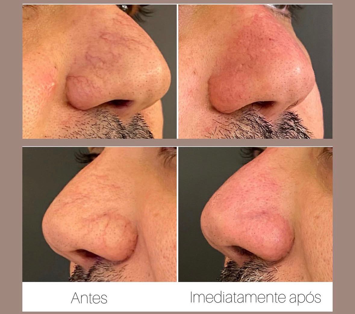 Antes e depois de telangiectasias com Laser
