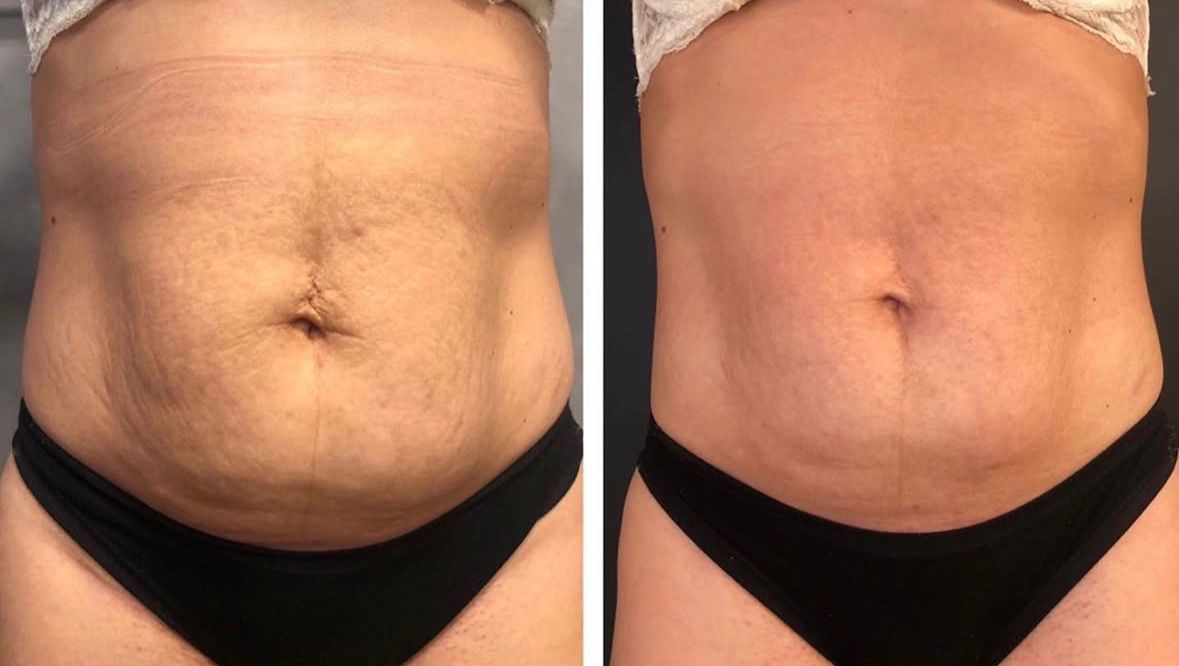 Antes e depois estrias e flacidez pós-gestação com CO2